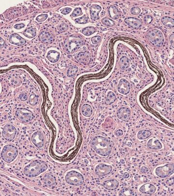 Comprehensive guide to the pathology, clinical features, and management of elastofibroma, a benign soft tissue tumour.