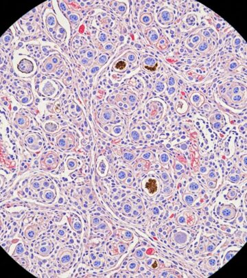 Understanding the pathological features and clinical significance of neurocristic hamartoma lesions.