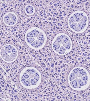 Comprehensive pathology of paracoccidioidomycosis, a systemic mycosis endemic to Latin America caused by dimorphic Paracoccidioides fungi.