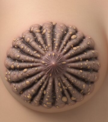 Explore the causes, symptoms, diagnosis, and management of hyperkeratosis of the nipple and areola, a benign yet uncommon skin condition.